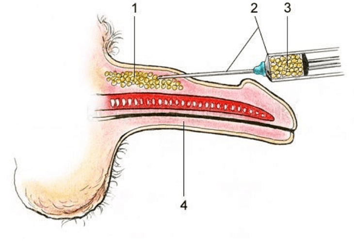 Le lipofilling est l’injection de tissu adipeux dans le pénis pour augmenter sa taille.