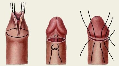Comment se déroule la chirurgie plastique du pénis 
