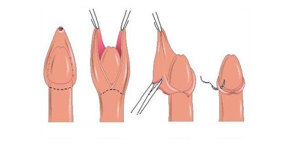 circoncision du prépuce pour augmenter la taille
